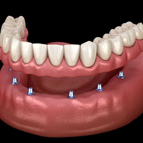 A 3D illustration of an implant denture and its parts