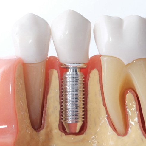Close-up of model of dental implant in Jersey City, NJ