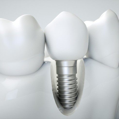 Render of dental implant in Jersey City, NJ in jawbone