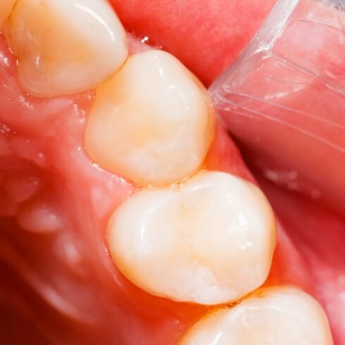 Closeup of smile after tooth colored filling treatment