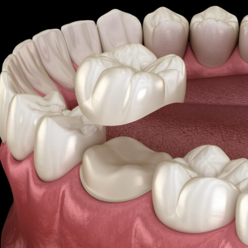 Animated smile during on visit dental crown placement