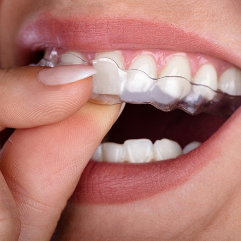 A woman placing a transparent aligner tray on her teeth
