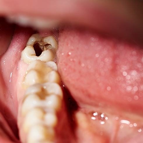 A severely decayed tooth in Jersey City