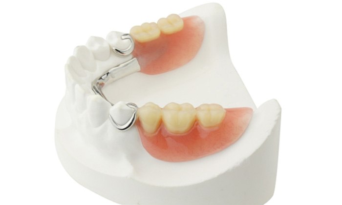 Partial dentures on dental model
