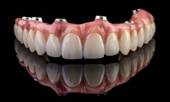 Implant dentures for upper arch against dark background