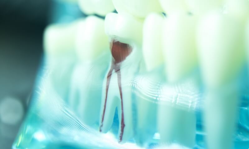Model tooth used to explain root canal therapy