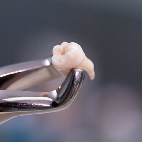 Tooth being held by dental forceps