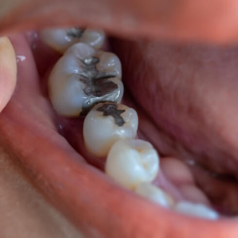 Closeup of smile with amalgam filling