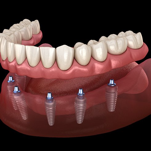 Illustration of dentures being attached to full-mouth dental implants in Jersey City