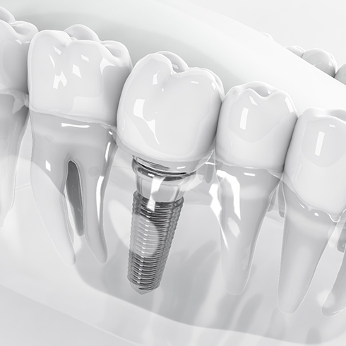 Close-up of model of dental implants in Jersey City, NJ