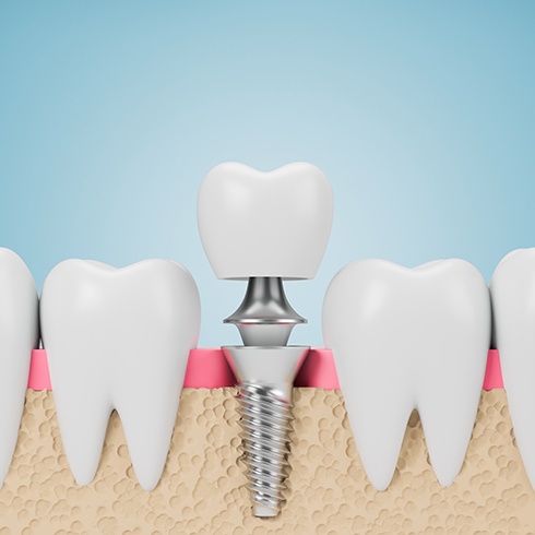 Illustration of dental implant in Jersey City, NJ with abutment and crown