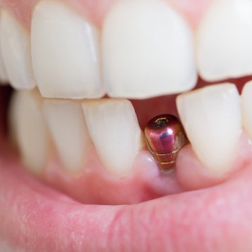 a person smiling with a dental implant in their mouth