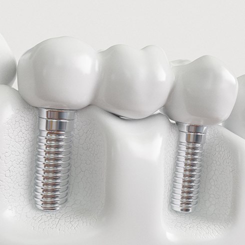 Illustration of dental implant bridge in Jersey City, NJ