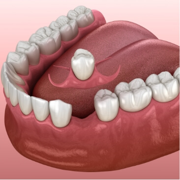 Animated smile during single tooth replacement