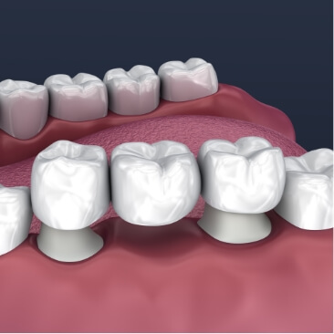 Animated smile during dental bridge placement
