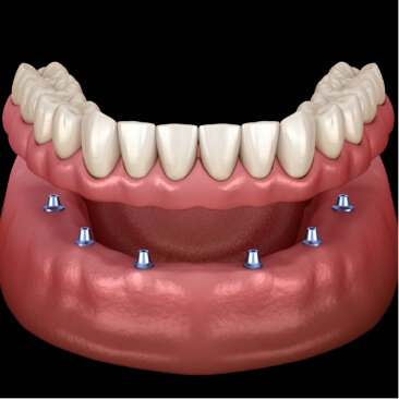 Animated smile during dental implant supported denture placement