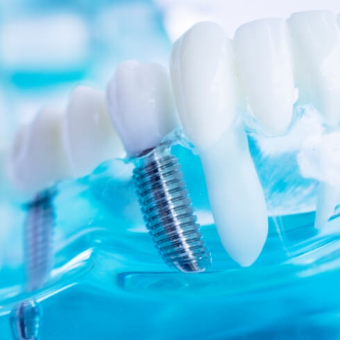 Closeup of model smile with dental implant supported fixed bridge