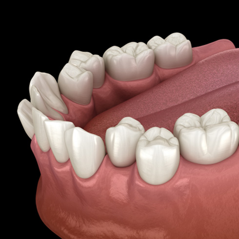 Side view illustration of crowded teeth