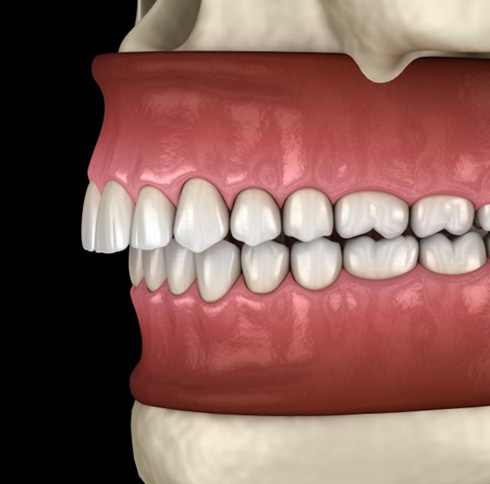 Illustration of misaligned jaws with an overbite