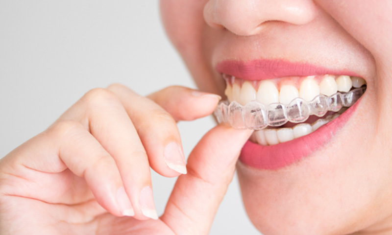 Woman putting on ClearCorrect tray 