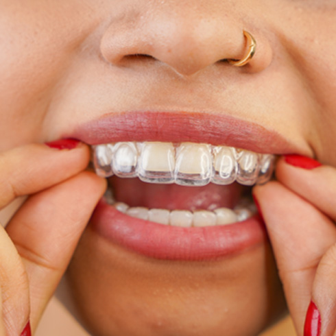 Closeup of woman putting on ClearCorrect aligner 