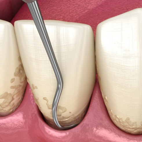 Animated smile during Arestin antibiotic therapy for gum disease