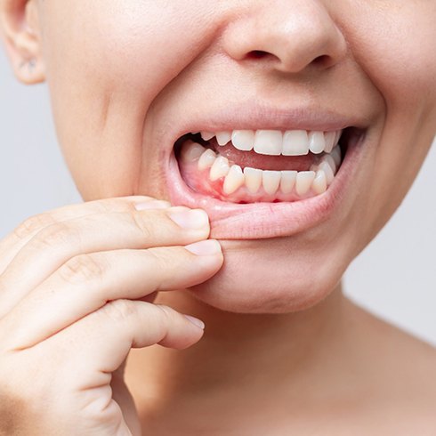 Woman pulling her lip down to show signs of gum disease