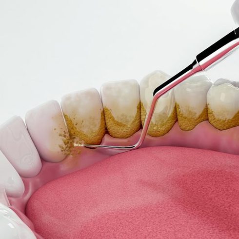 Illustration of dental instrument cleaning the teeth