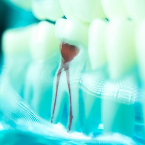 Model tooth used to explain root canal therapy
