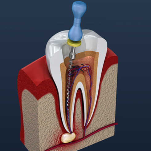 Illustration of the file being used to perform root canal treatment