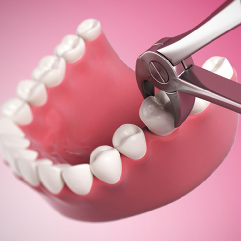 Illustration of forceps being used to extract tooth