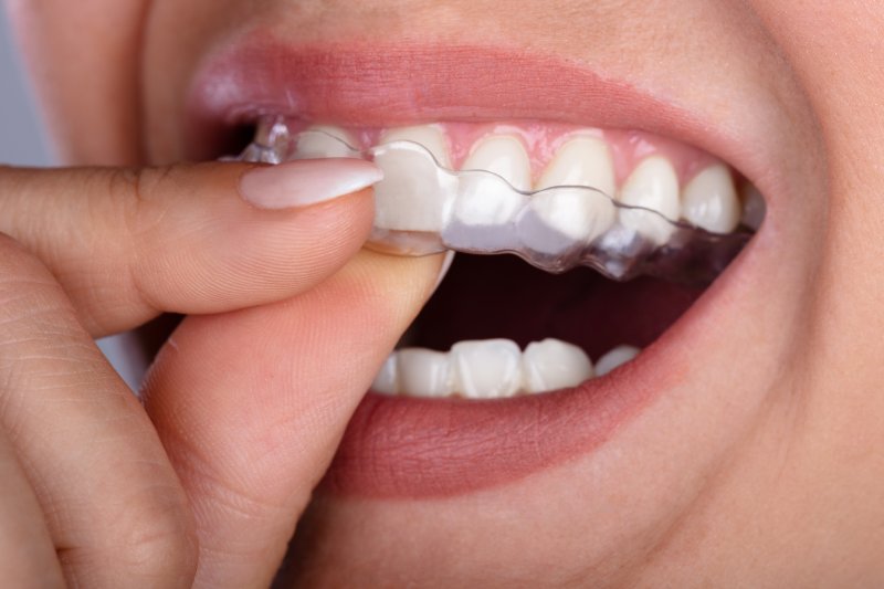 A woman wearing ClearCorrect aligners