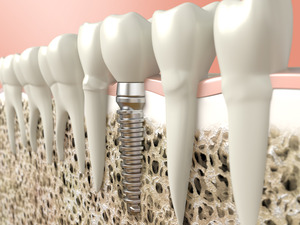 Illustration of a dental implant in the jaw