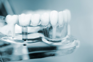 Close-up of dental implants in a plastic tray