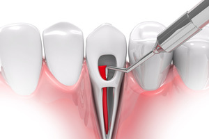 Illustration of root canal treatment being performed on tooth in lower arch